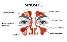 la sinisitis